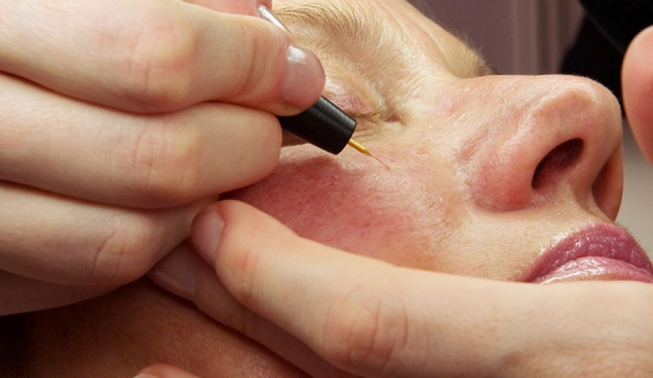 Yanakta ve Vücutta Kılcal Damar Çıkması ve Tedavisi 7