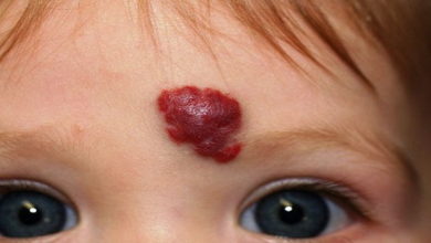 Hemanjiom (Damar Beni, Doğum Lekesi) Nedir, Nasıl Tedavi Edilir? 1