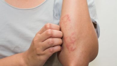 Meslek ve hobi egzama sebebi olabilir 16