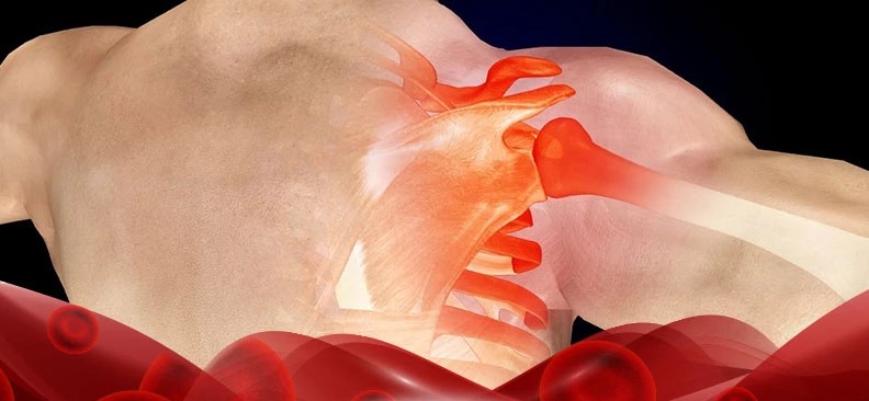 Torasik Outlet Sendromu 1