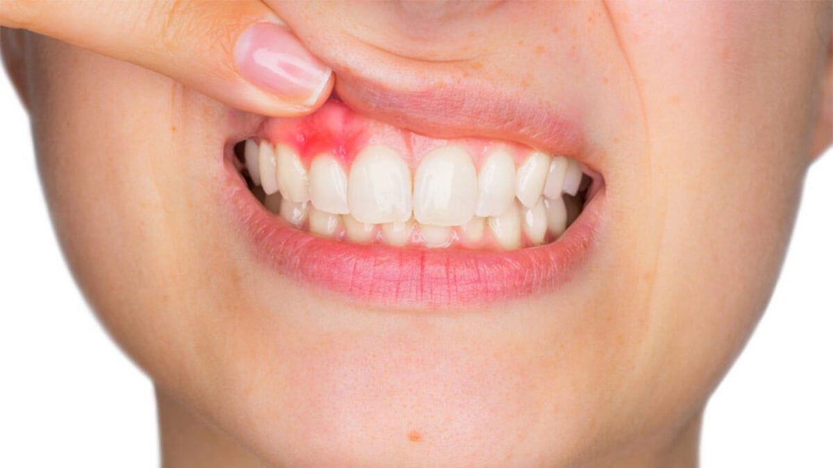 Gingivektomi Nedir? — haber görseli