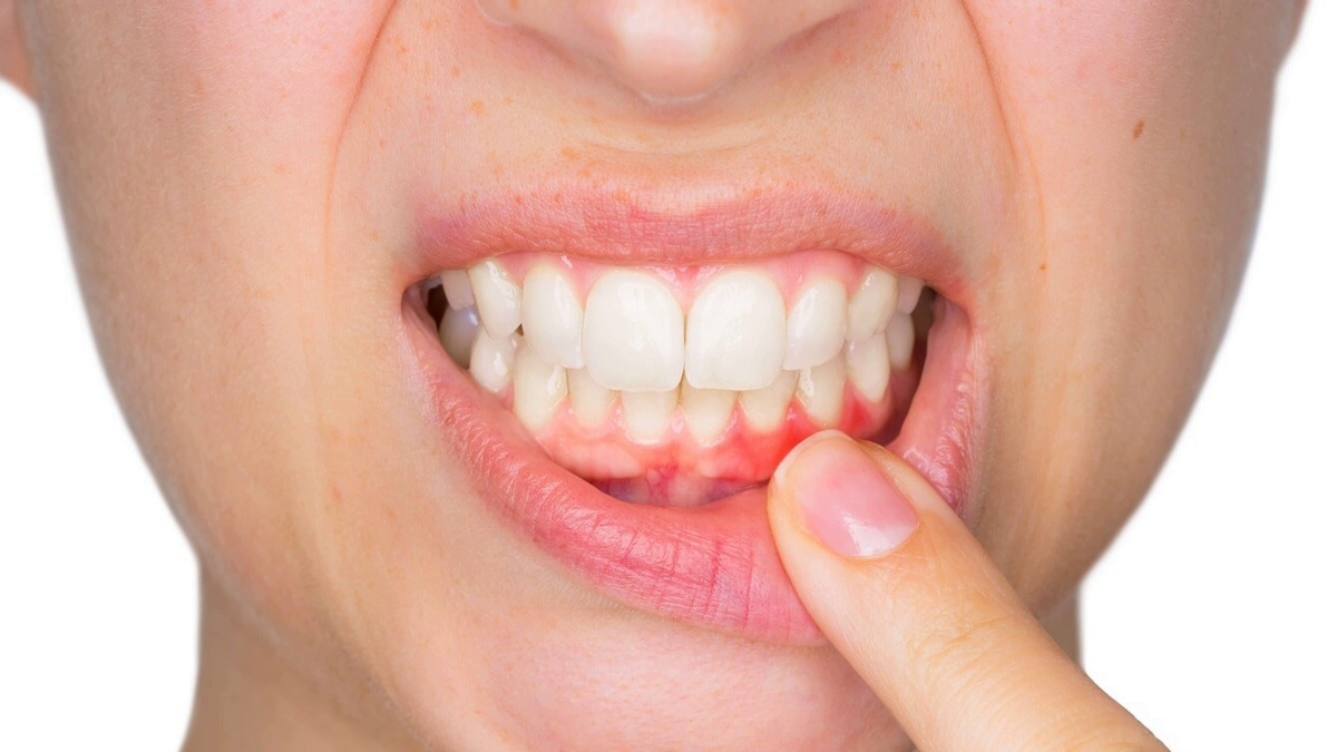 Diş Eti Hastalıkları Nedir? — haber görseli