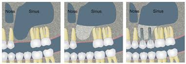 Sinüs Lifting İşlemi 27