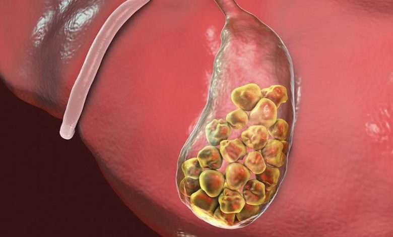 Safra Kesesi Taşları 7