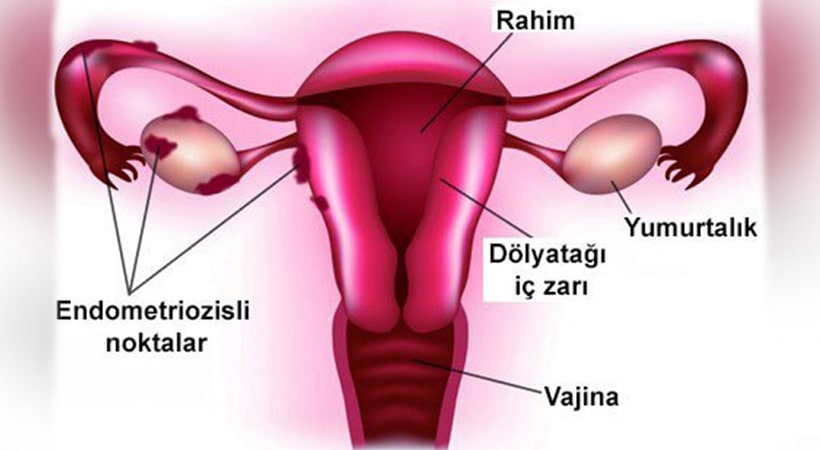 Endometriozis 7