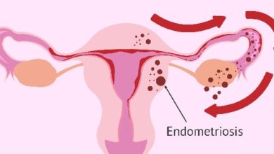 Endometriozis belirtileri nelerdir? 1