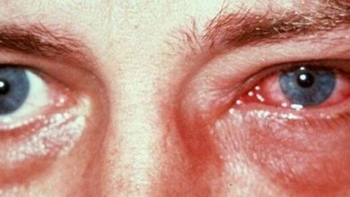 Yaz Aylarımızın Kabusu Adenovirüs Konjonktiviti 21