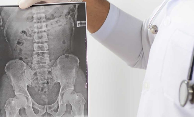 Tedavi Edilmeyen Bel Ağrısı Kamburluğa Yol Açabilir 24