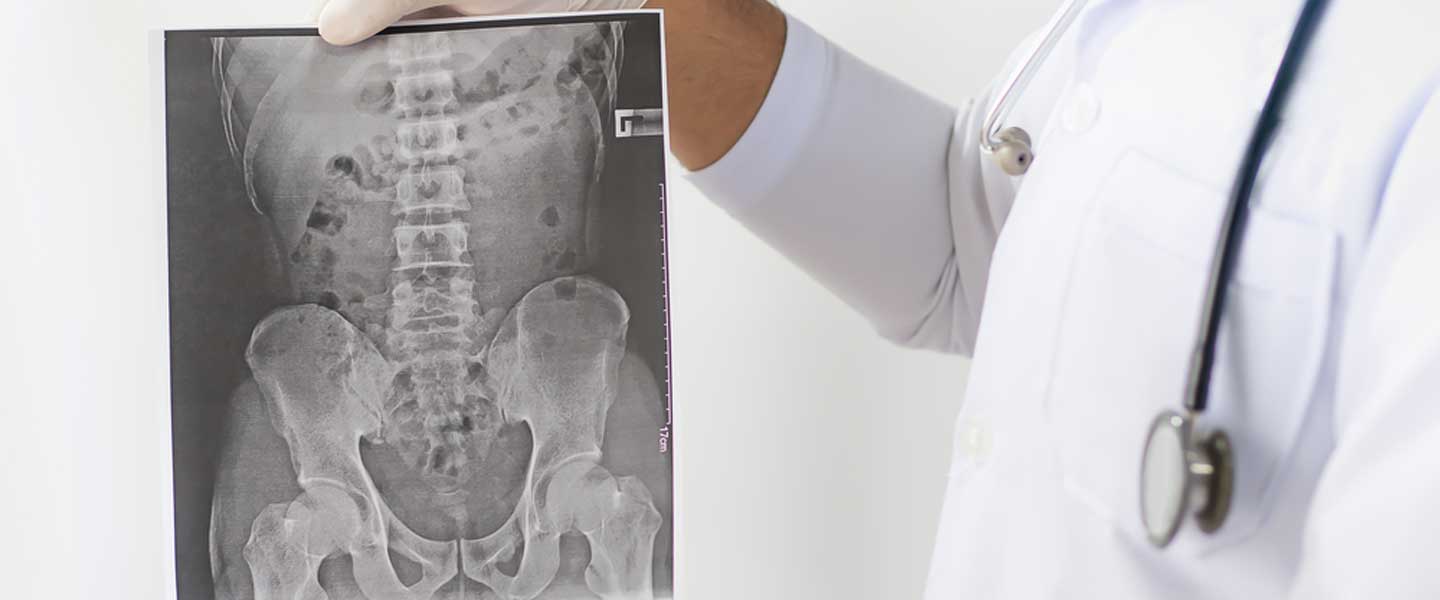 Tedavi Edilmeyen Bel Ağrısı Kamburluğa Yol Açabilir 1