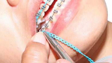 Ortodonti Tedavisinde Merak Edilenler 17