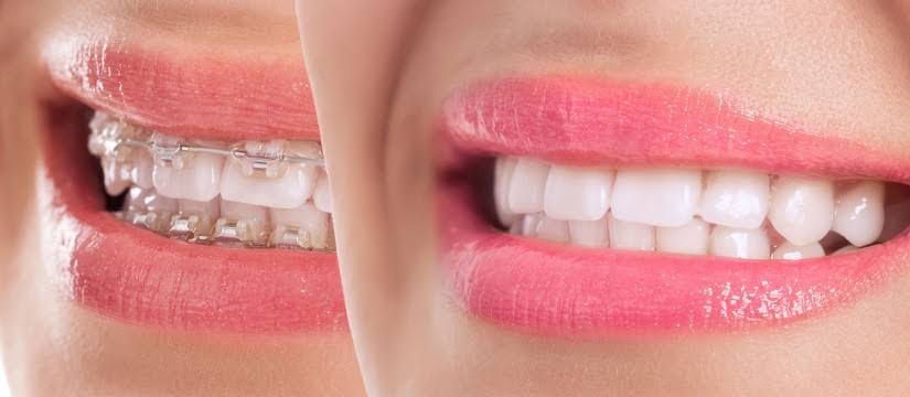 Horlama ve Ortodonti İle İlişkisi 1