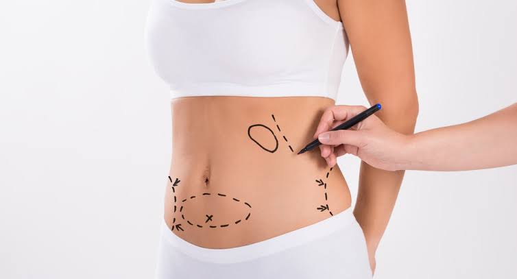 Liposuction 1