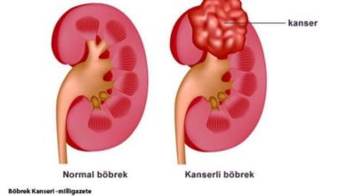 Böbrek Kanseri 3