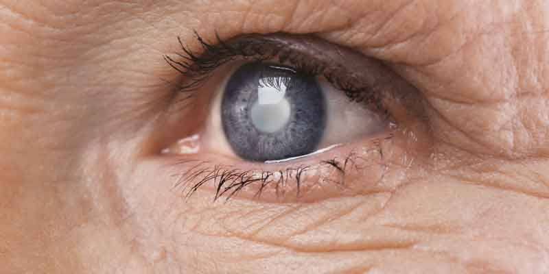 Katarakt Nedir? Nasıl Tedavi Edilir? 1