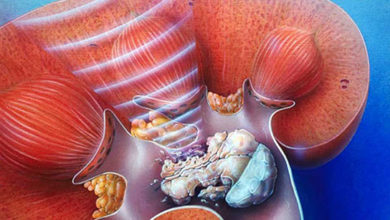 Böbrek & Üreter & Mesane Taşları 1