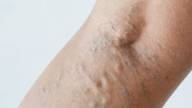 Kılcal variste yeni tedavi yöntemi 3