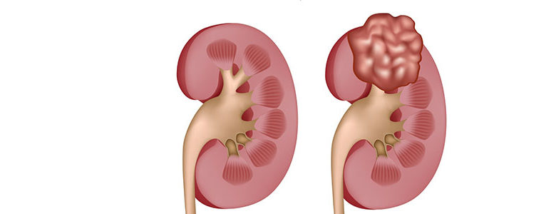 Akkiz Böbrek Kisti Hastalığı 1