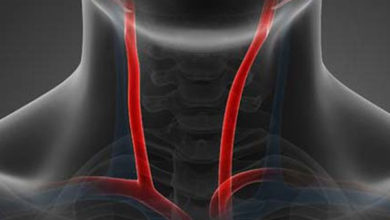 Karotid arter (şah damarı) darlıkları ve damar yoluyla tedavisi 11