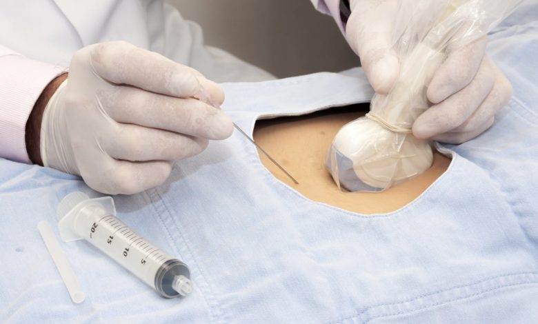 Amniyosentez nedir, neden yapılır, riski var mıdır? 1