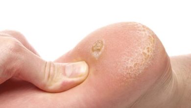 Nasır tedavi yöntemleri 1