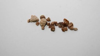 Böbrek taşı nedir? Belirtileri nelerdir? Nasıl oluşur? Tedavisi nedir? Tedavi olmazsa ne olur? 1