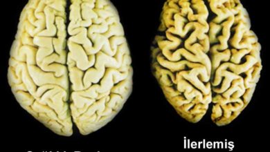 Alzheimer hastalığının evreleri nelerdir? 1