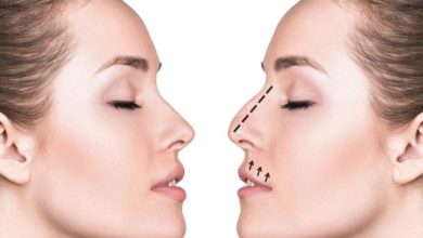 Estetik burun ameliyatları 1