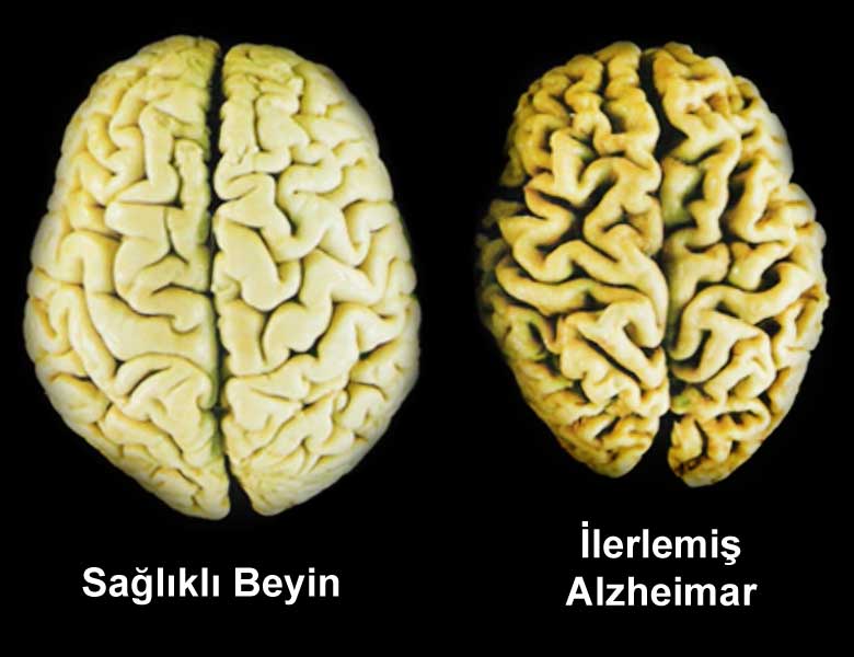 Alzheimer hastalığının evreleri nelerdir? 7