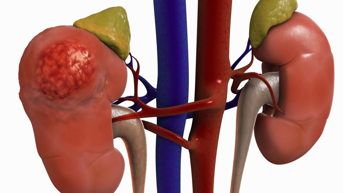 Böbrek üstü bezleri ve böbrek üstü bezleri tümörlerinin yol açtığı hastalıkları nelerdir? 7