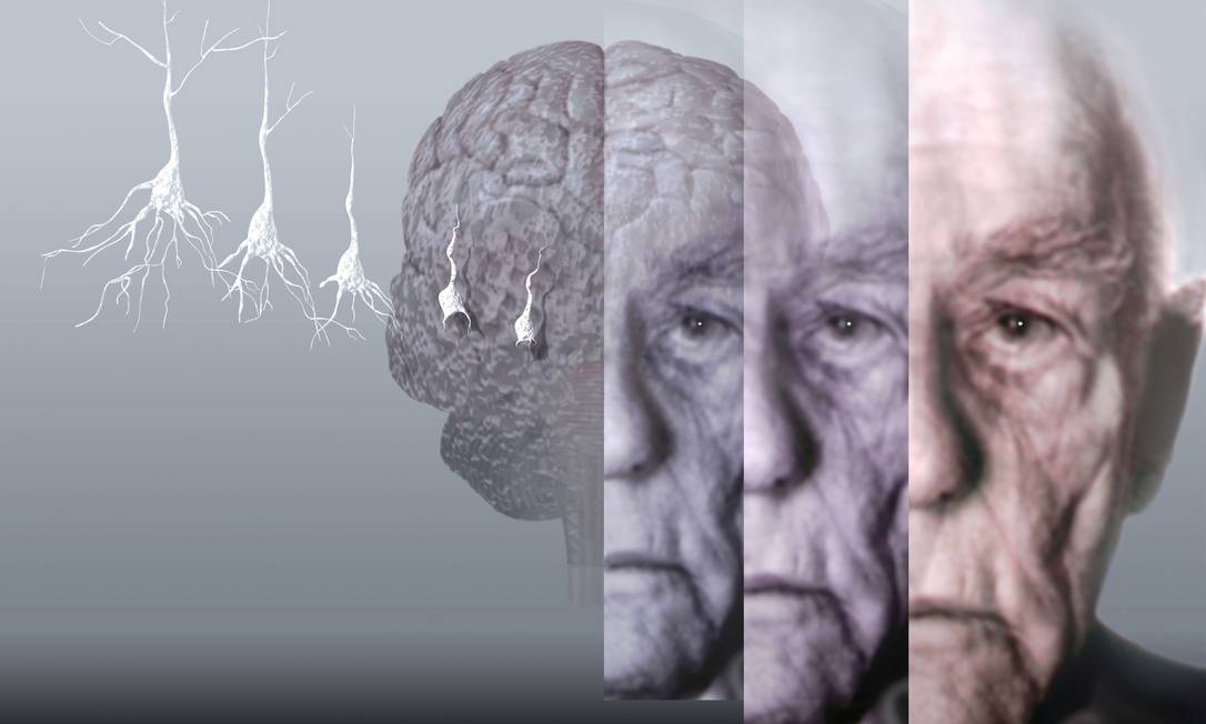 Alzheimer nedir ? 1