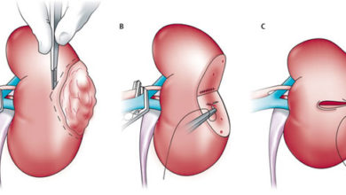Böbrek kanseri (tümörü) 1