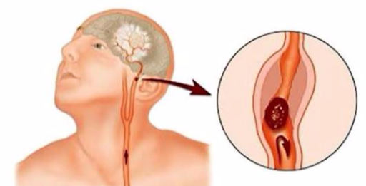 Çağımızın önemli hastalıklarından inme 7