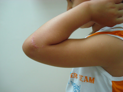 Çocuk dirsek yaralanmaları 8