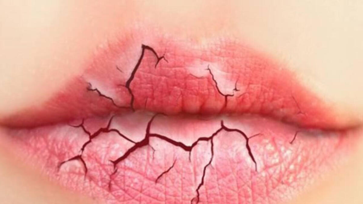 Dudak kanseri nedir ? Türleri, sebepleri ve tedavisi hakkında 7