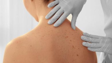 Cilt kanseri tedavisi 5