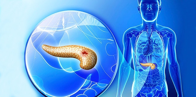 Pankreas kanseri önlenebilir mi ? 1