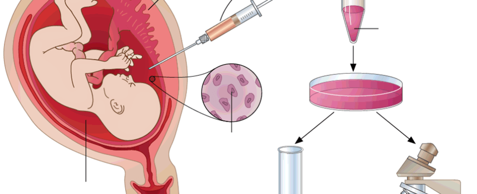 Koryon villus biyopsisi - koryon villus örneklemesi (cvs) nedir? Neden yapılır? 7
