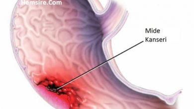 Erken mide kanseri tedavisi 3