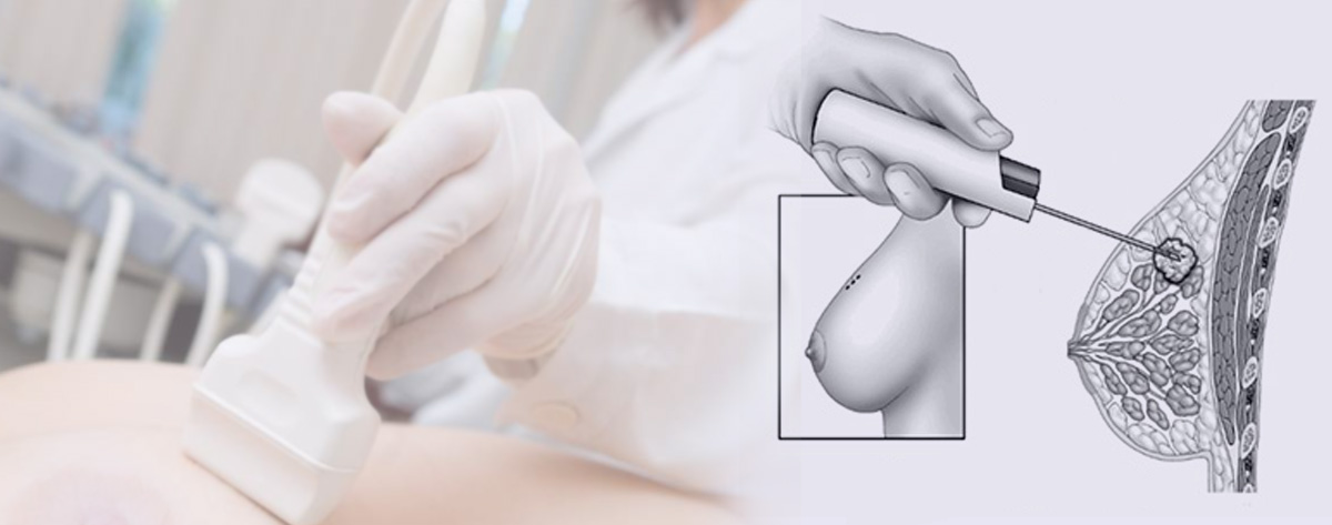 Gereksiz meme biyopsilerinden kendinizi korumak için on altın öneri! 7