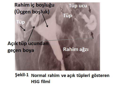Hsg (histero-salpingo-grafi): 3