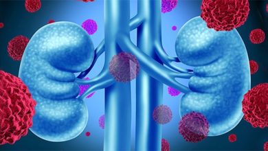 Böbrek kanseri (tümörü) belirtileri, bulguları, teşhisi 9