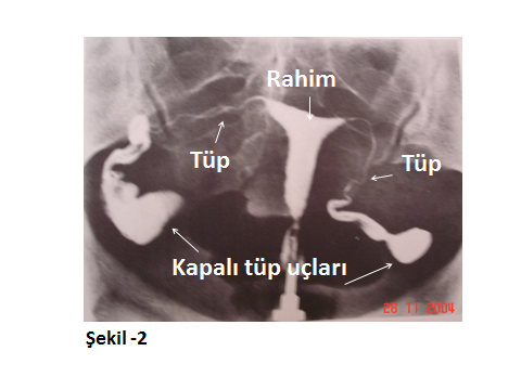 Hsg (histero-salpingo-grafi): 4