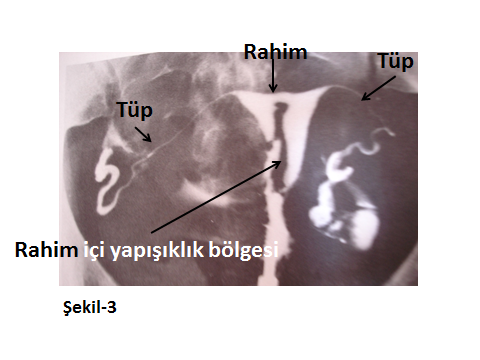 Hsg (histero-salpingo-grafi): 5