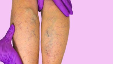 Varis, belirtileri ve ameliyatsız tedavi yöntemi 1