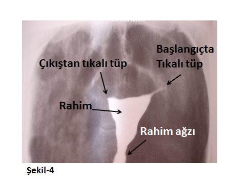 Hsg (histero-salpingo-grafi): 6