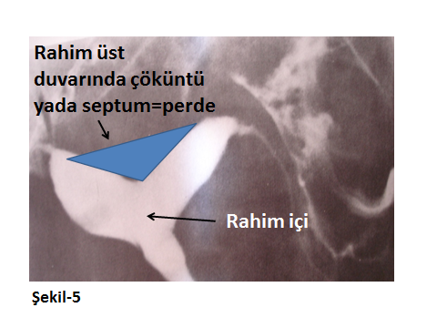 Hsg (histero-salpingo-grafi): 7