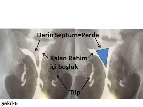 Hsg (histero-salpingo-grafi): 8