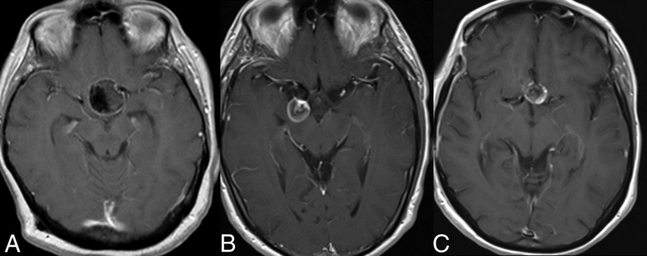 Dural arteriovenöz fistüller (dural avf, davf) 7