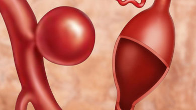 Serebral (beyin) anevrizmaları (baloncuk) 3