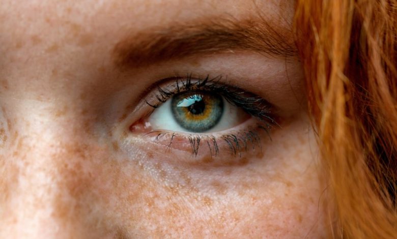 Çil nedir, neden meydana gelir ? 1